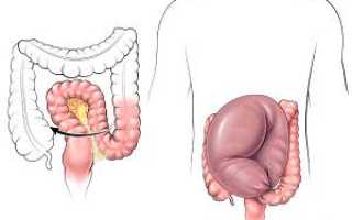 Долихосигма кишечника. Лечение у взрослых, детей. Что это, симптомы, питание, народные средства, удаление