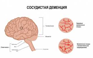 Сосудистая деменция. Симптомы, лечение у пожилых