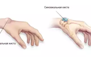 Шишка на запястье на руке сверху. Гигрома под кожей. Лечение народными средствами, мази, удаление лазером, хирургическим путем