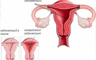 Гипоплазия эндометрия. Что это такое, лечение, причины возникновения