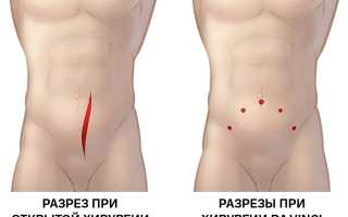 Простатэктомия радикальная. Реабилитация, последствия, отзывы
