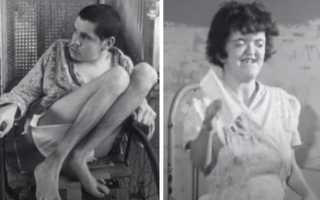 Идиотизм (Идиотия). Это что за болезнь, симптомы, причины