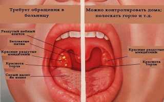 Ангина. Симптомы и лечение у взрослых, лекарства-антибиотики, народные средства