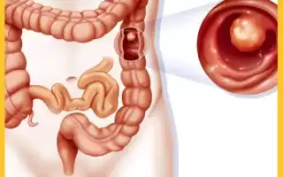 Полипы в кишечнике. Симптомы и лечение, причины образования, признаки. Как обнаружить, удалить, диета, питание, клизма. Анализ крови, операция, какой наркоз