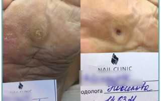Удаление стержневой мозоли в косметическом салоне лазером, жидким азотом, в домашних условиях