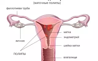 Полип эндометрия. Симптомы, признаки в матке, отчего появляются