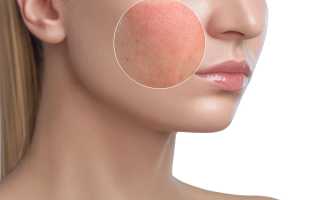 Шелушится и краснеет кожа лица. Причины и признаки заболеваний, лечение