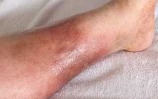 Рожистое воспаление ноги, голени. Симптомы, лечение в домашних условиях антибиотиками, народные средства, медикаментозное
