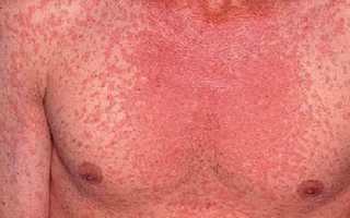 Признаки кори у взрослых. Симптомы, фото, как проявляется, лечение, инкубационный период