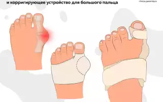 Артроз большого пальца ноги. Лечение народными средствами