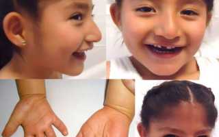 Синдром Ангельмана у детей. Что это такое, симптомы, стадии, фото