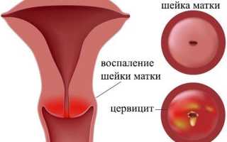Воспаление шейки матки. Причины возникновения, симптомы, лечение