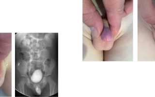 Скопление смегмы (смегмалит) у ребенка. Фото, как выглядит у мальчиков под крайней плотью, лечение