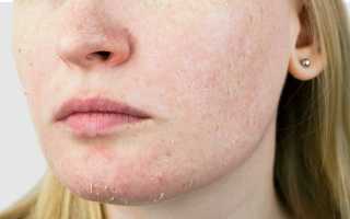 Шелушится кожа на лице у женщин. Причины, что делать, как избавиться в домашних условиях