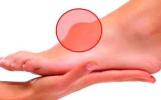 Как убрать гигрому на ноге без операции?