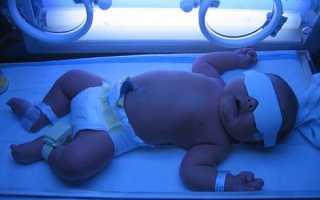 Фототерапия для новорожденных при желтухе. Сколько длится, побочные эффекты