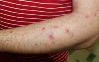 Почесуха. Симптомы, фото, лечение, первые признаки. Что такое узловая, детская, старческая болезнь Бенье