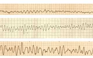 Фибрилляция желудочков. Это что такое