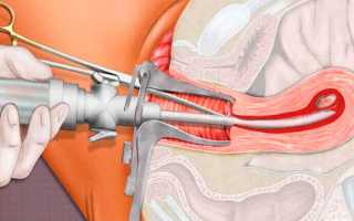 Миниаборт — что это, на каком сроке делают, как проходит, способы прерывания беременности