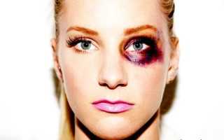 Гематома. Как избавиться, чем рассосать, лечить, убрать быстро