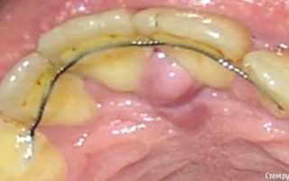 Болит небо, как будто обожгла, вскочил бугорок, шишка. Причины, что делать, лечение