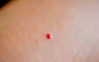 Красные родинки на теле у мужчин и женщин. Что это значит, причины и лечение