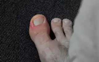 Панариций на пальце руки, ноги. Классификация, лечение, фото