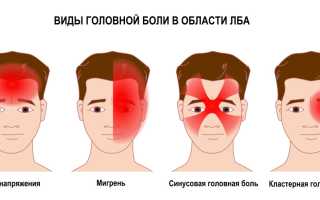 Головная боль в лобной части. Причины, что означает, лечение
