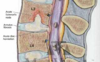 Грыжа Шморля на позвоночнике. Фото, что это такое, симптомы и лечение, опасность