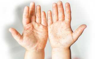 Энтеровирусная инфекция у детей — симптомы и лечение, фото. Как и чем лечить сыпь на коже в домашних условиях, диета, препараты