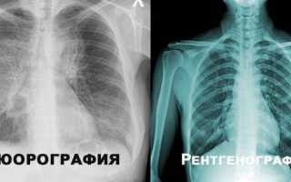 Флюорография и рентген легких. Чем отличается, разница