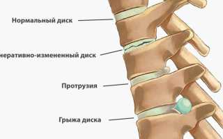 Дорзальная протрузия диска, межпозвонковых дисков. Что это