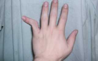 Что делать, если вывихнул палец на руке