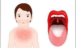 Стрептококк в мазке из зева у ребенка, взрослого. Что это, норма, лечение