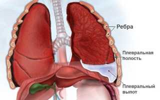 Жидкость в легких. Причины, почему скапливается, как откачивают, лечение и последствия