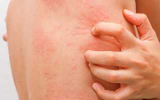 Мелкие прыщики по телу чешутся, болят. Что это может быть, фото, лечение