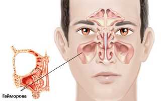 Гайморотомия эндоскопическая и радикальная. Что это такое