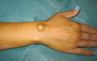 Страшная шишка  — гигрома на руке. Решение проблемы существует!