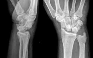 Вывих кисти руки. Лечение, что делать, симптомы, рентген