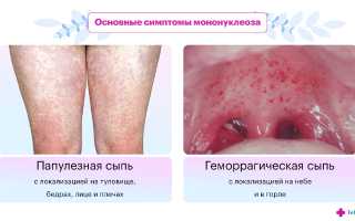 Мононуклеоз. Симптомы и лечение у взрослых: инфекционный, хронический, атипичный. Чем опасен, как передается, последствия