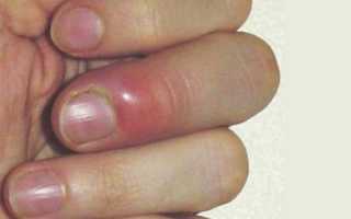 Нарыв пальца руки