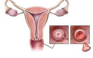 Конизация шейки матки. Что такое в гинекологии