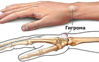 Причины возникновения гигром и особенности этой патологии