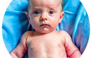 Синдром угнетения у новорожденных. Что это, последствия, лечение