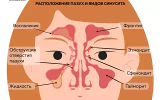 Катаральное воспаление. Что это такое, лечение верхних дыхательных путей, среднего уха, пазух носа