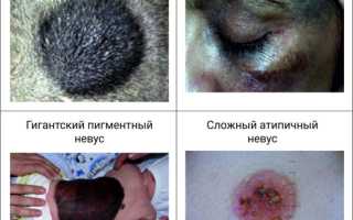 Виды родинок на теле, лице. Фото с описанием, опасны или нет