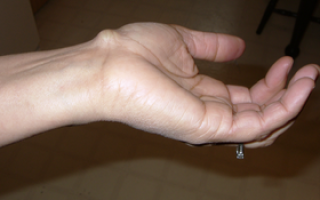 Гигрома на запястном суставе: причины и лечение