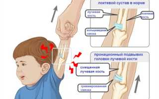 Вывих локтевого сустава у детей. Симптомы, восстановление, лечение