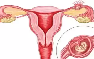 Воспаление яичников у женщин. Симптомы и лечение в домашних условиях