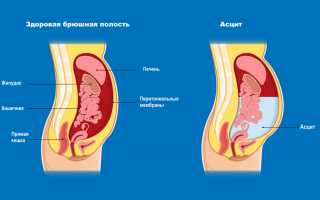 Жидкость в малом тазу у женщины. Причины, что это значит, лечение